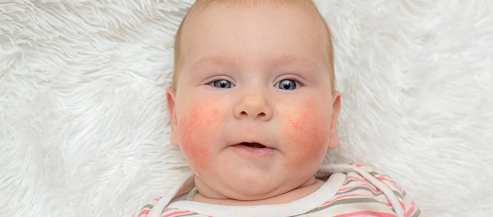 Baby with rash