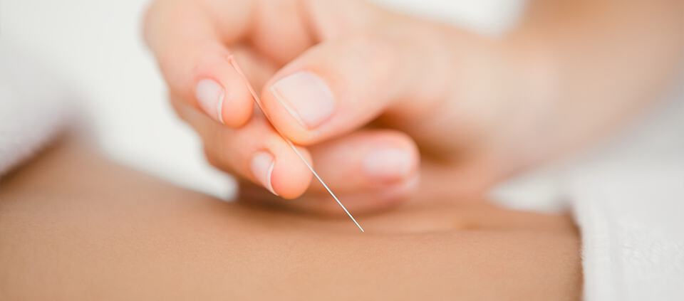 Woman getting acupuncture