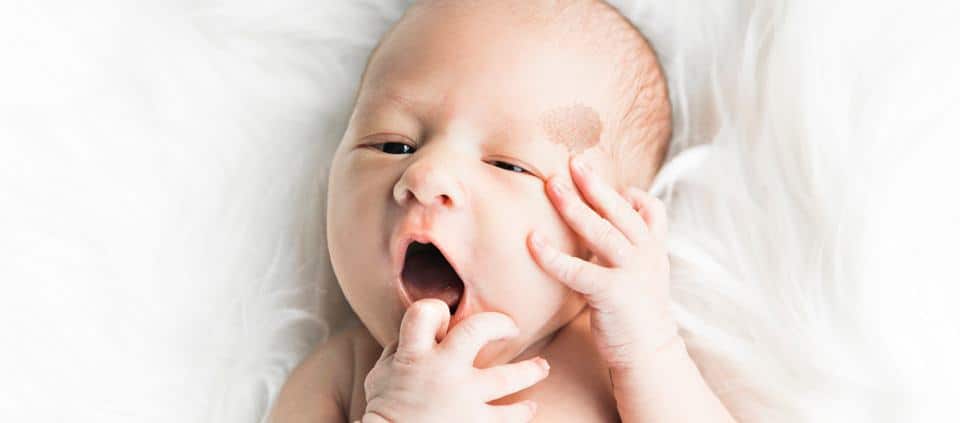 Baby with a birthmark yawning