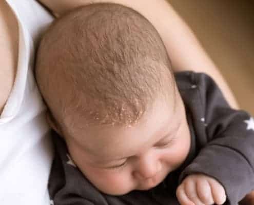 Baby with Cradle Cap